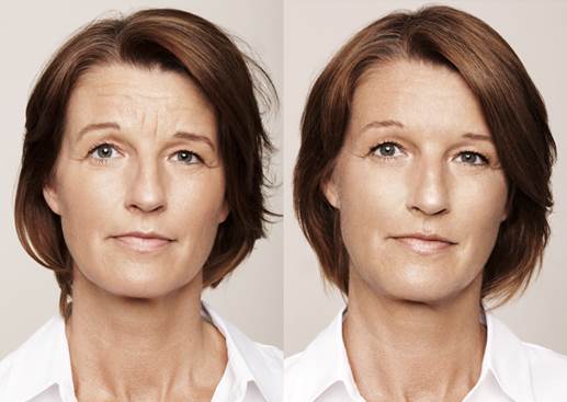 Facial Enhancements Without Surgery